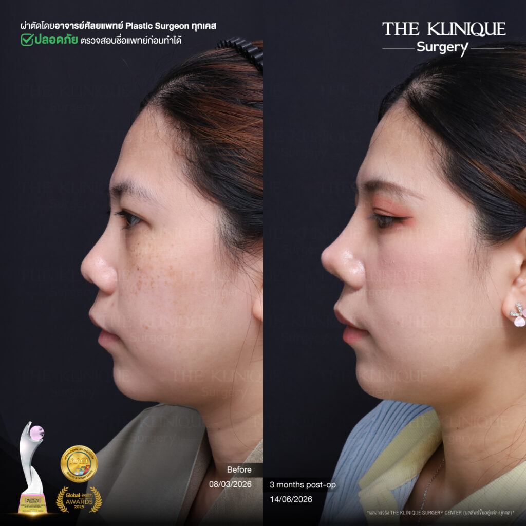 รีวิวเสริมจมูกแบบปิด (Closed)