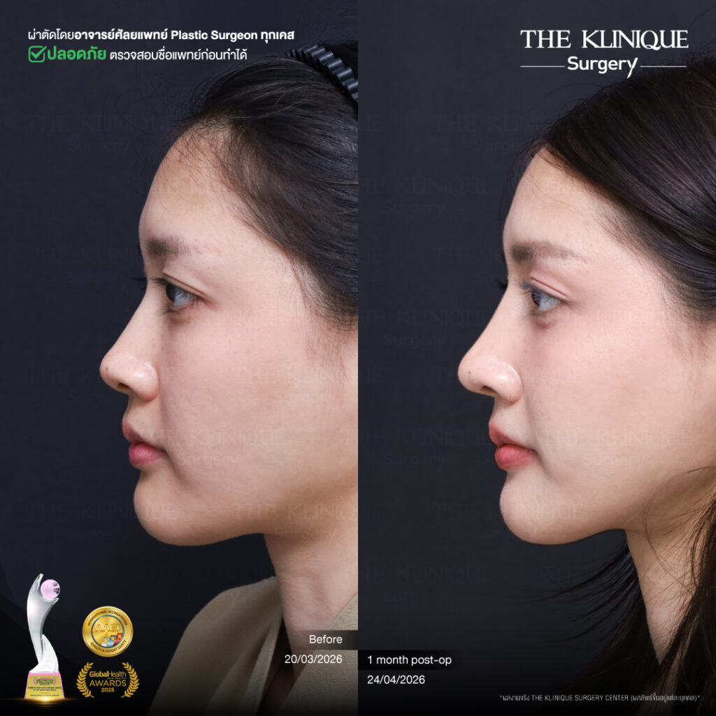 รีวิวเสริมจมูกแบบปิด (Closed)