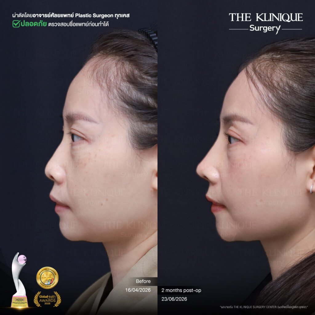รีวิวเสริมจมูกแบบปิด (Closed)