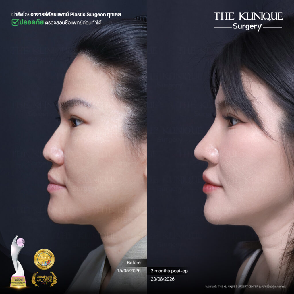 รีวิวเสริมจมูกแบบปิด (Closed)