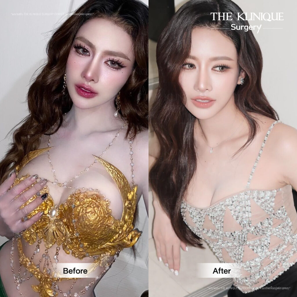 Before After รีวิวแก้หน้าอก