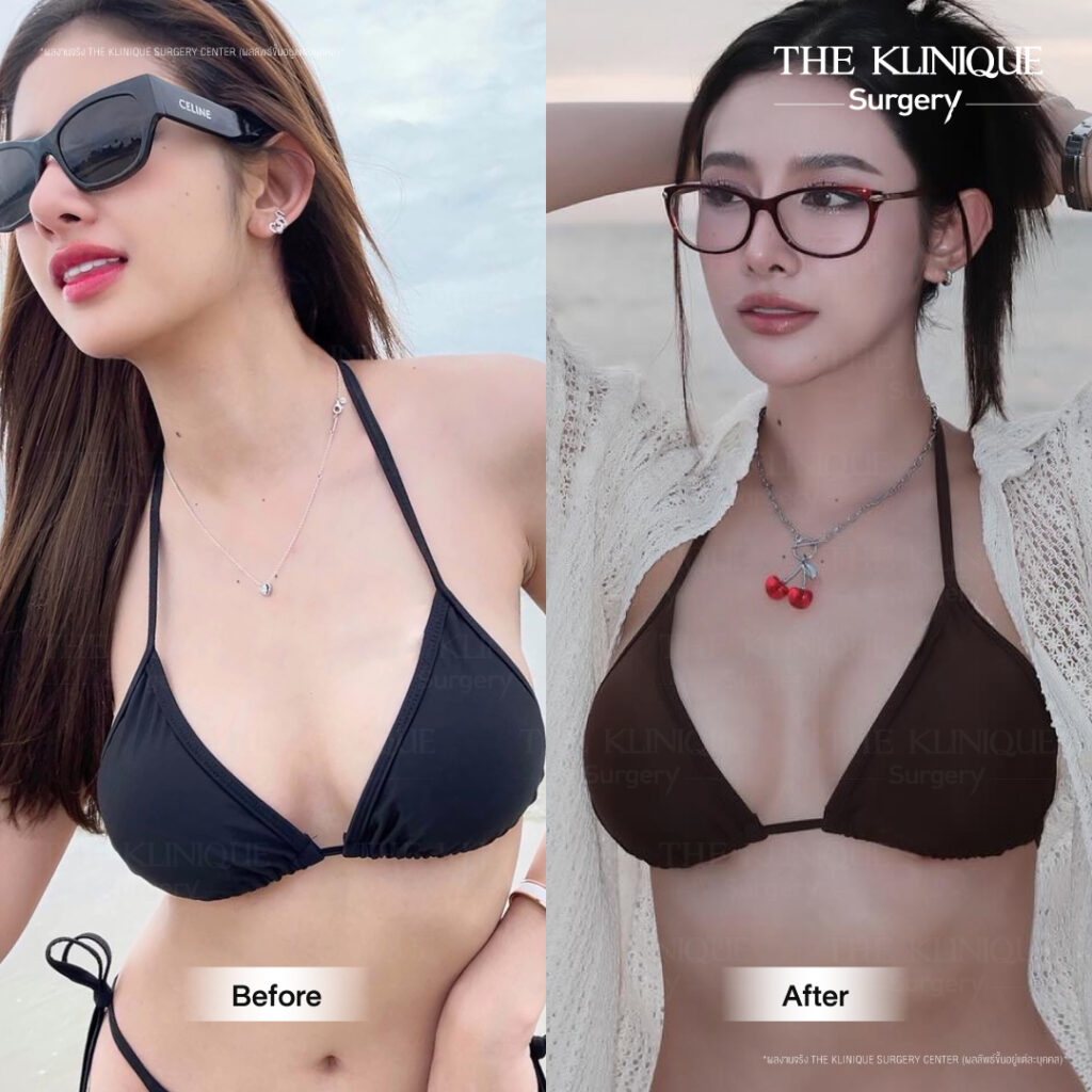 Before After รีวิวแก้หน้าอก