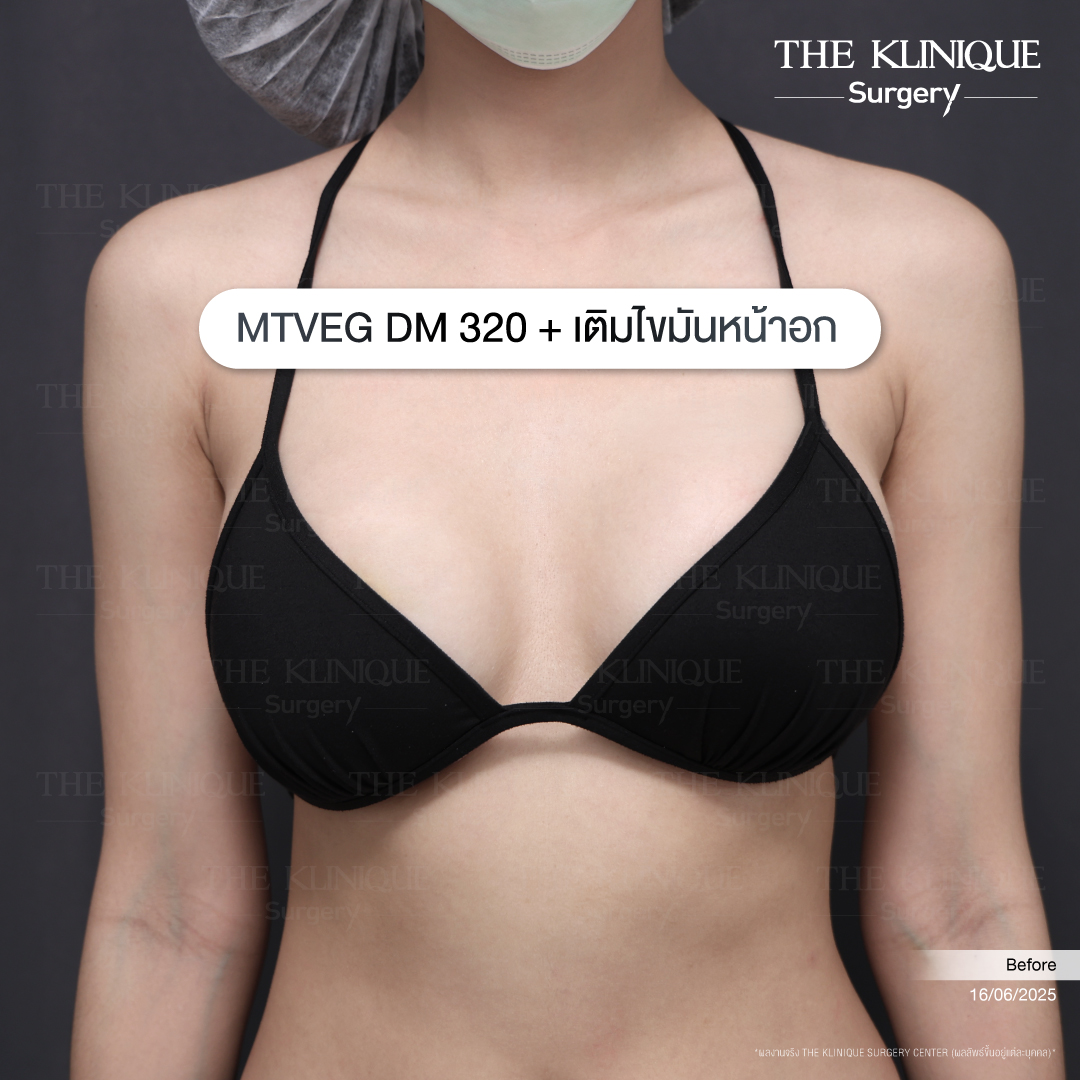 รีวิวแก้หน้าอก